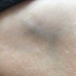 Selling a vain in my ankle